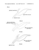 Custom-fitted blood vessel sleeve diagram and image