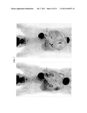 Detection of Early-Stage Pancreatic Adenocarcinoma diagram and image