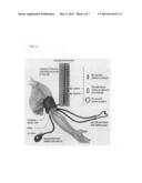 Inflatable cuff with built-in drug delivery device for dynamic drug     therapy response to blood pressure incidents diagram and image