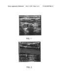 HERBAL POLYPHARMACEUTICAL FOR PREVENTING AND TREATING ATHEROSCLEROSIS diagram and image