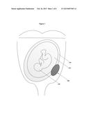 Method for Administering a Medicament to a Fetus diagram and image