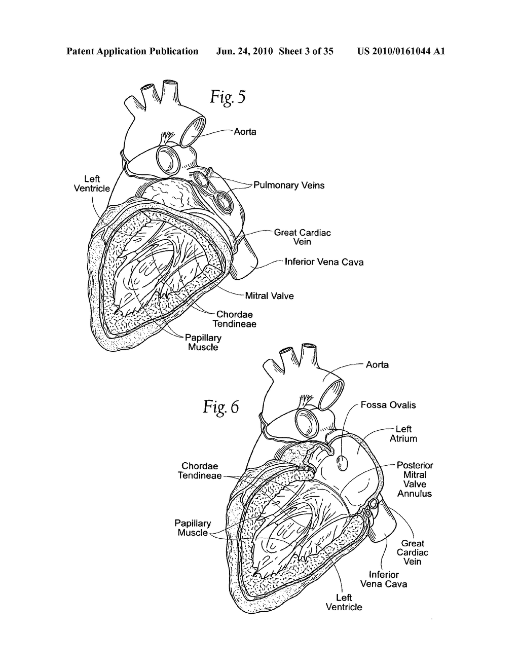 Devices, systems, and methods for reshaping a heart valve annulus - diagram, schematic, and image 04