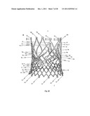 Prosthetic Heart Valve And Transcatheter Delivered Endoprosthesis     Comprising A Prosthetic Heart Valve And A Stent diagram and image