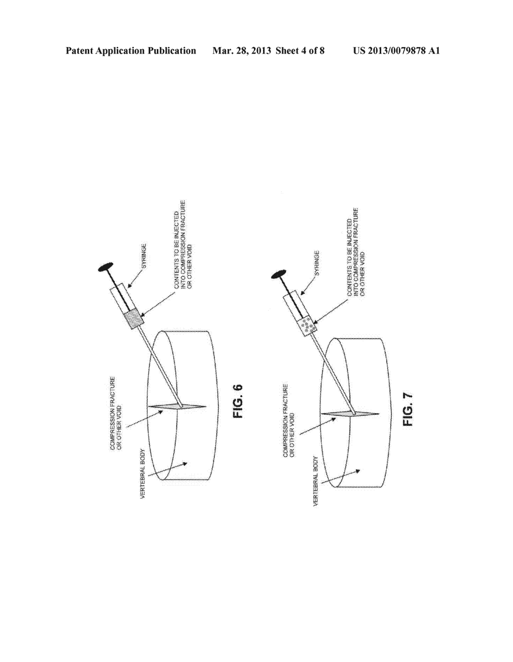 METHOD AND APPARATUS FOR TREATING COMPRESSION FRACTURES IN VERTEBRAL     BODIES - diagram, schematic, and image 05